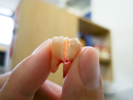 智牙拔牙多少钱一颗